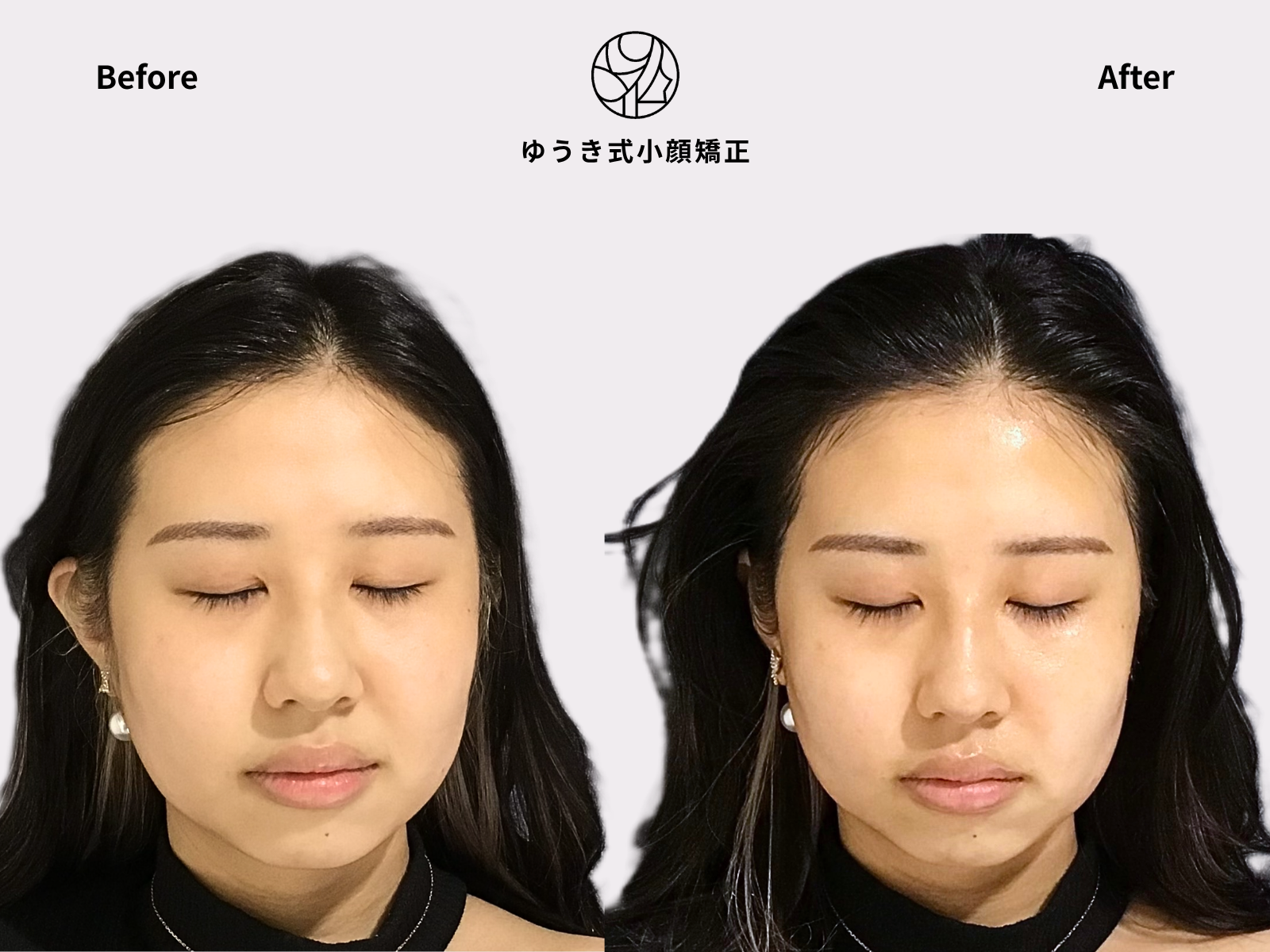 顔の歪みが気になる 20代女性 Before After｜ゆうき式小顔矯正