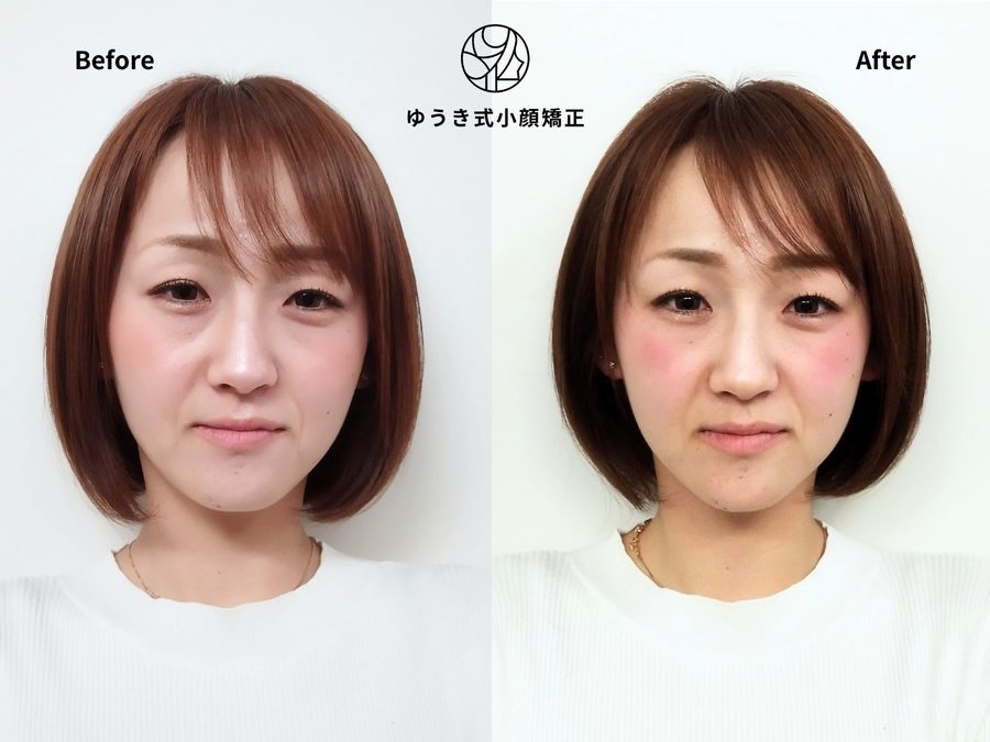 産後の変化が気になる 20代女性 Before After｜ゆうき式小顔矯正