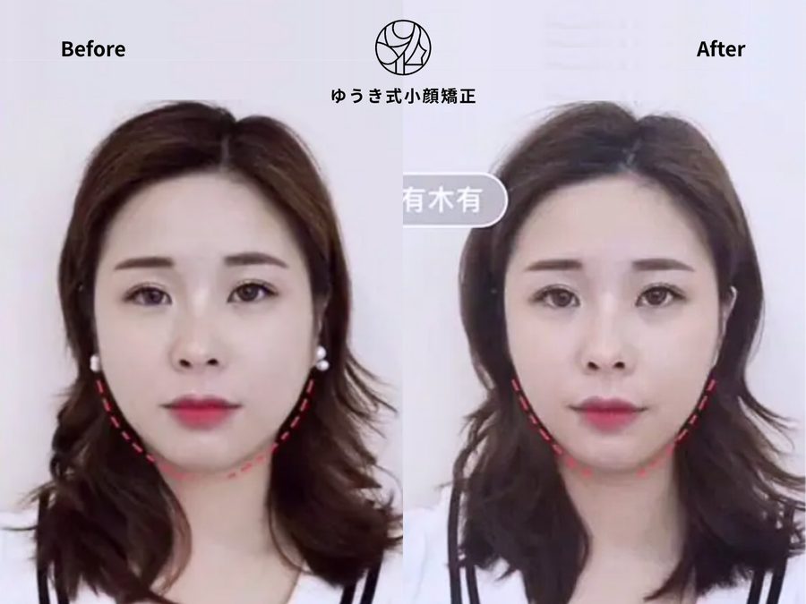 CASE 02 とにかく小顔になりたい Before After｜ゆうき式小顔矯正