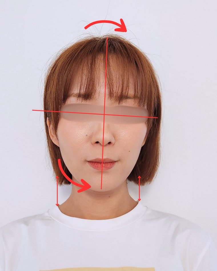 CASE 03 顔の歪み、むくまない顔にしたい 顔の歪み解析｜ゆうき式小顔矯正