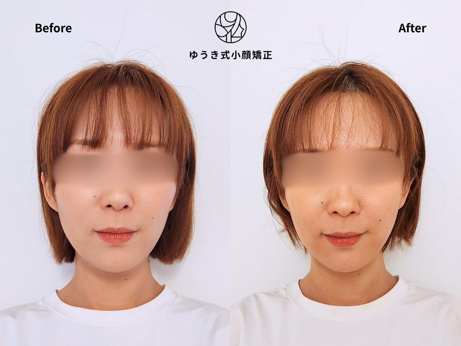 顔の歪み・むくみが気になる 30代女性 Before After｜ゆうき式小顔矯正