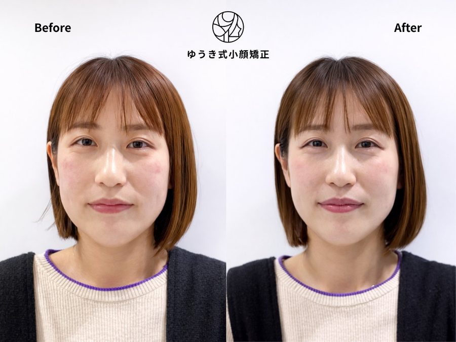 加齢による変化が気になる 40代女性 Before After｜ゆうき式小顔矯正