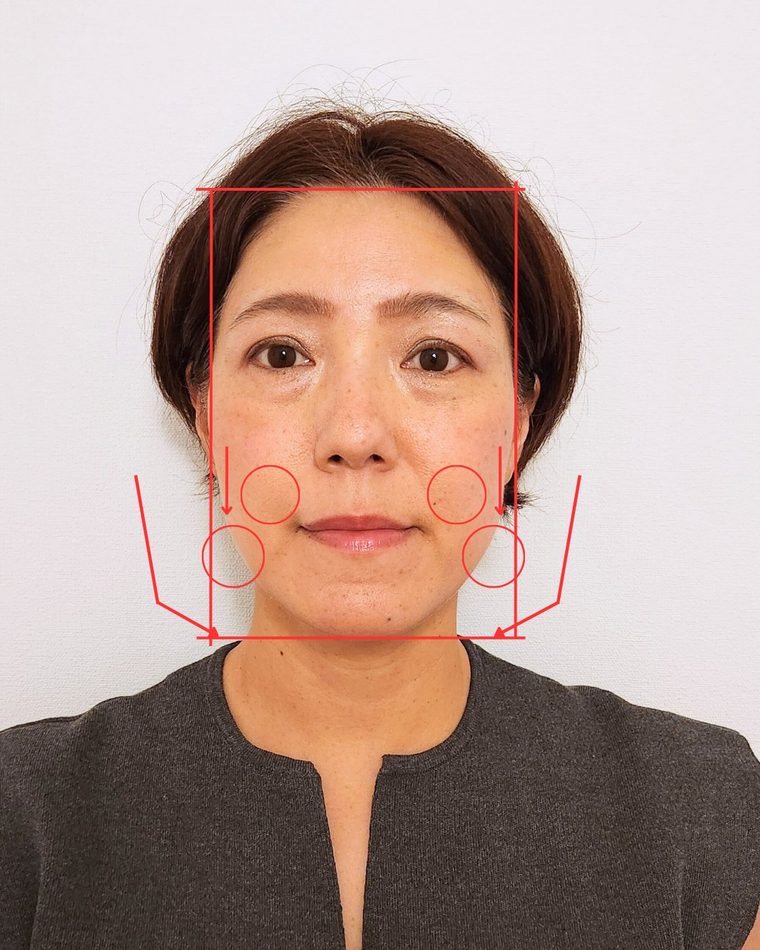 CASE 05 たるみと顔が伸びた気がする 顔の歪み解析｜ゆうき式小顔矯正