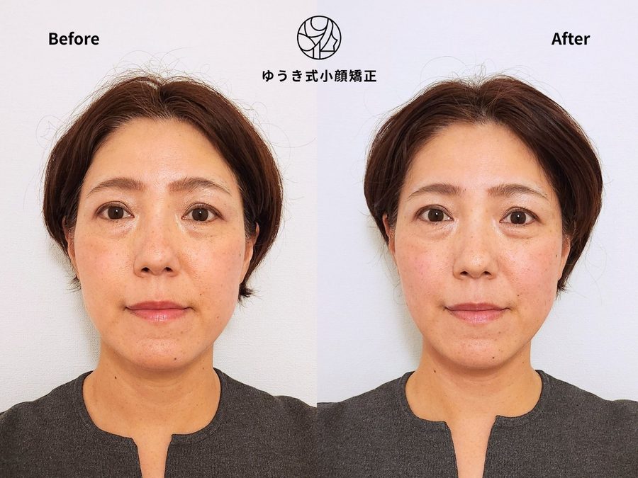 たるみが気になる 50代女性 Before After｜ゆうき式小顔矯正